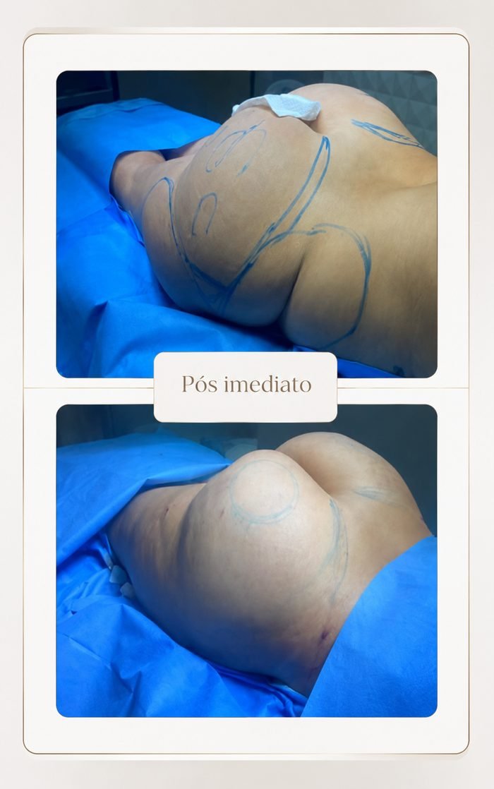 Resultado pós-operatório imediato de lipoaspiração
